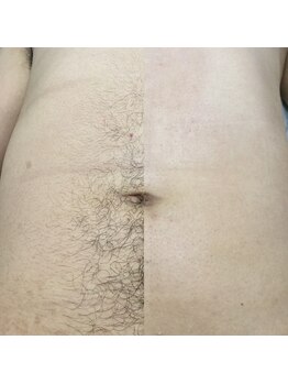 メンズサロンエヌエー(MEN'S SALON NA)/【お腹脱毛】