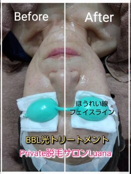 ルアナ(Luana)/BBL光でふっくらしたお肌に♪