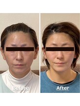 小顔22 ボルティ 赤坂支店(Bolty)/小顔シンメトリー矯正＆全身矯正