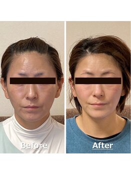 小顔22 ボルティ 赤坂支店(Bolty)/小顔シンメトリー矯正＆全身矯正