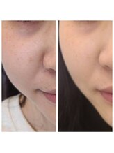 ビハダ(BeHADA)/#ダイエット/脂肪分解/引締