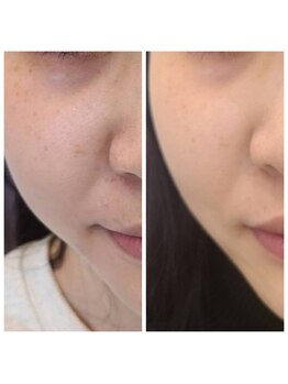 ビハダ(BeHADA)/#ダイエット/脂肪分解/引締