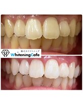 ホワイトニングカフェ 守山店/12回コース症例写真