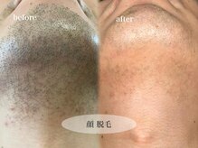 ビジュー(bjyou)/メンズ脱毛