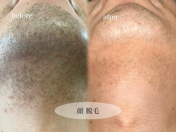 ビジュー(bjyou)/メンズ脱毛