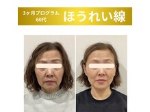 スリー治療院 伏見桃山(THREE治療院)/【ほうれい線改善】小顔矯正