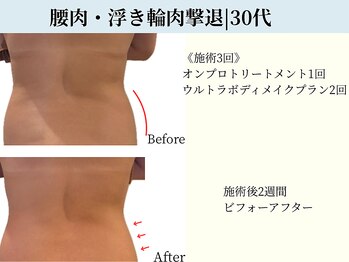 京都フォーエイチ(京都4H)/産後|腰周り|浮き輪肉|お肉とり