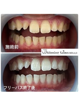 ホワイトニングサロン 京都烏丸店/ホワイトニング施術例