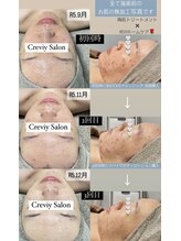 クレヴィー(Creviy)/陶肌トリートメント×ホームケア