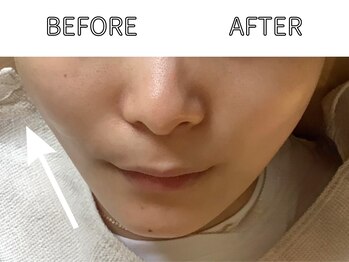 ライム バイ アネラ 高崎(LIME By Anela)/ハーブピーリング/肌質改善