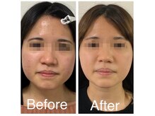 ルビー 新宿(Ruby)/小顔だけじゃない、美肌効果も！