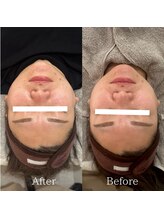 ラ フルール(La Fleur)/エアバリフェイシャル