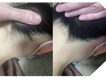 アディ(Adiy)/安心都度払いの美肌脱毛