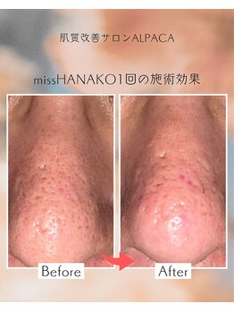 アルパカ(ALPACA)/missHANAKO