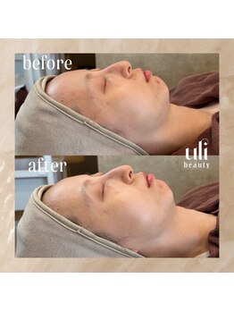 ウリ(uli beauty)/比較写真