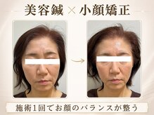 リノ ショウナン(LINO SHONAN)/美容鍼×小顔矯正