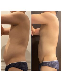 心斎橋 ルヴィ(REVI)の写真/【男性のお客様大歓迎!】モテBODYへ!そのぽっこりお腹を本気で変える◎結果重視★ハイパーナイフEX