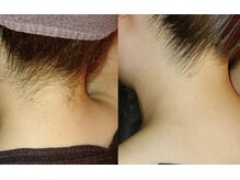 アネル うるま店(anel)/夏に向けてうなじ脱毛♪