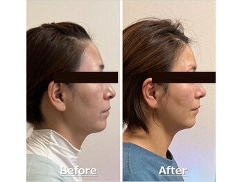 小顔22 ボルティ 赤坂支店(Bolty)/小顔シンメトリー矯正＆全身矯正