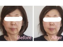 小顔矯正サロン ブルーム/施術1回のビフォーアフター