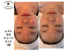 アネランスパ(Anelan Spa.)/ヒト幹細胞で赤ら顔ニキビケア