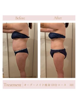 エミル(Emillu)/＊Body_ビフォーアフター