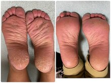 ルノン(LUNON)/希少よもぎ蒸しビフォーアフター