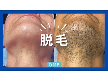 ワン(ONE)/メンズ脱毛！！