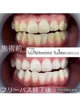 ホワイトニングサロン 京都烏丸店/ホワイトニング施術例