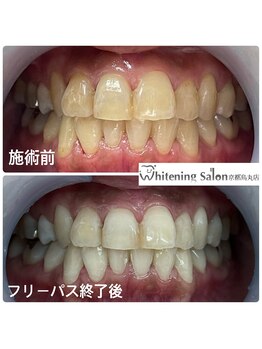 ホワイトニングサロン 京都烏丸店/ホワイトニン施術例