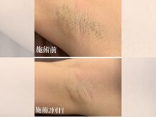 エクラ(eclat)/脇脱毛