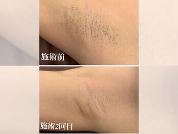 エクラ(eclat)/脇脱毛