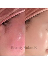 ケイ(K)/防府｜赤みニキビ集中改善コース