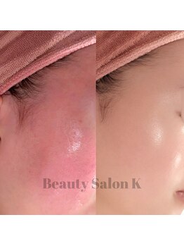ケイ(K)/防府|赤みニキビ集中改善コース