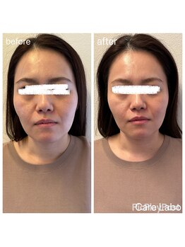 ケアラボ(Care Labo)/【FN美容鍼】