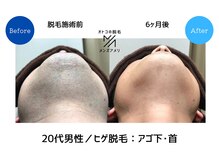 メンズアメリ/高知/メンズ脱毛/ヒゲ/全身/VIO