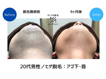 メンズアメリ/高知/メンズ脱毛/ヒゲ/全身/VIO