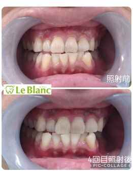 ルブラン 奈良店(Le Blanc)/4回目の照射でこんなに変化♪