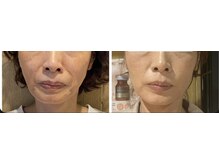 ねこのひげ/お顔の変化