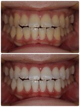 ホノルルホワイトニング 京橋店/12回券 ホワイトニング症例写真