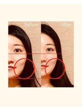 カームアライン(CALM ALIGN)/札幌/小顔矯正/ビフォーアフター