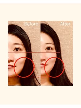 カームアライン(CALM ALIGN)/札幌/小顔矯正/ビフォーアフター