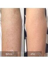 ビューティリュクス(beauty luxe)/ボディーの肌荒れケア