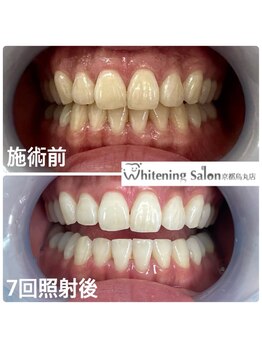 ホワイトニングサロン 京都烏丸店/ホワイトニング施樹例