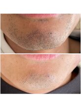 ビーボヌール(be-bonheur)/痛みの少ないメンズヒゲ脱毛