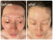 エヌエースキン 北谷店(NAskin)/ハーブピーリング｜美白ケア