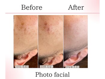 サロンツキ(salon tuki)/光フェイシャル/フォト/症例