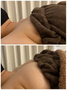 スマイルクルー(SmileClue)/初回ビフォーアフター症例