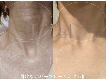 ヴィーダ 渋谷松濤(ViDA)/首デコルテ肌荒れ改善