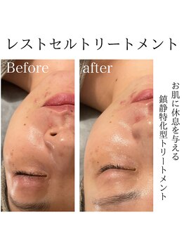 パールムーン(pearl moon)/レストセルトリートトメント